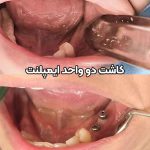 عکس قبل و بعد ایمپلنت,نمونه کار ایمپلنت,ویدیو قبل و بعد ایمپلنت,عکس بعد از ایمپلنت,عکس ایمپلنت فک پایین
