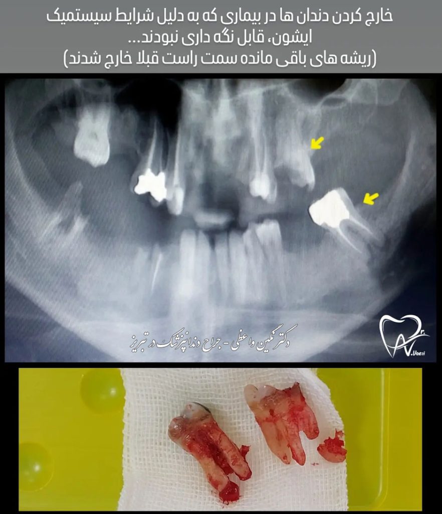 کشیدن دندان های پایین و بالا - ریشه دندان - عکس قبل و بعد کشیدن