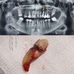 عکس قبل و بعد کشیدن دندان نیش فک بالا سمت چپ بیمار - کشیدن دنان شماره 3 با عفونت شدید توسط دکتر نگین واعظی تبریز