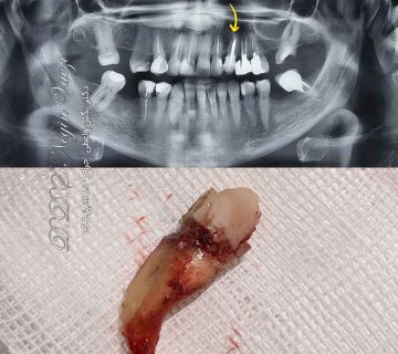 عکس قبل و بعد کشیدن دندان نیش فک بالا سمت چپ بیمار - کشیدن دنان شماره 3 با عفونت شدید توسط دکتر نگین واعظی تبریز