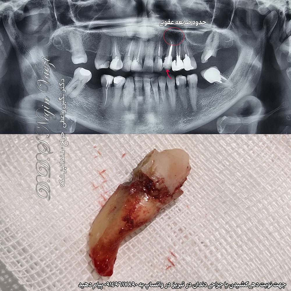 عکس کشیدن دندان نیش بیمار ، کشیدن دندان 3 یا کانین به شدت عفونی توسط دکتر نگین واعظی در تبریز