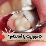 پرکننده دندان,پرکردن دندان با آمالگام,پرکردن دندان با کامپوزیت,ترمیم آمالگام,ترمیم کامپوزیت,پرکردگی همرنگ دندان,فرق کامپوزیت و آمالگام