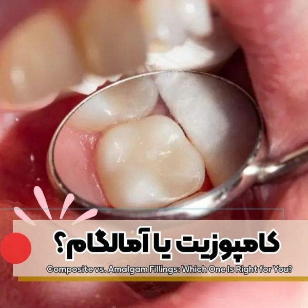 پرکننده دندان,پرکردن دندان با آمالگام,پرکردن دندان با کامپوزیت,ترمیم آمالگام,ترمیم کامپوزیت,پرکردگی همرنگ دندان,فرق کامپوزیت و آمالگام