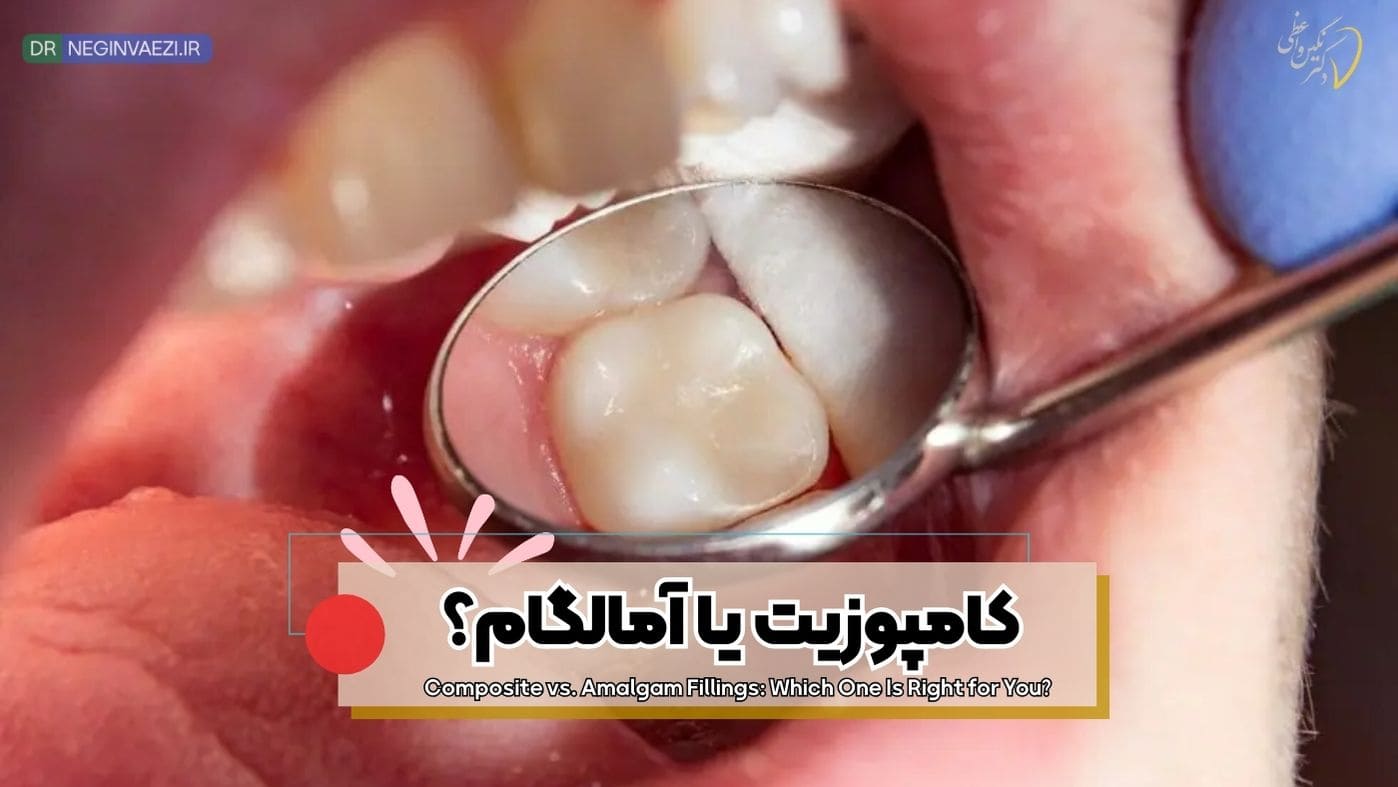 پرکننده دندان,پرکردن دندان با آمالگام,پرکردن دندان با کامپوزیت,ترمیم آمالگام,ترمیم کامپوزیت,پرکردگی همرنگ دندان,فرق کامپوزیت و آمالگام