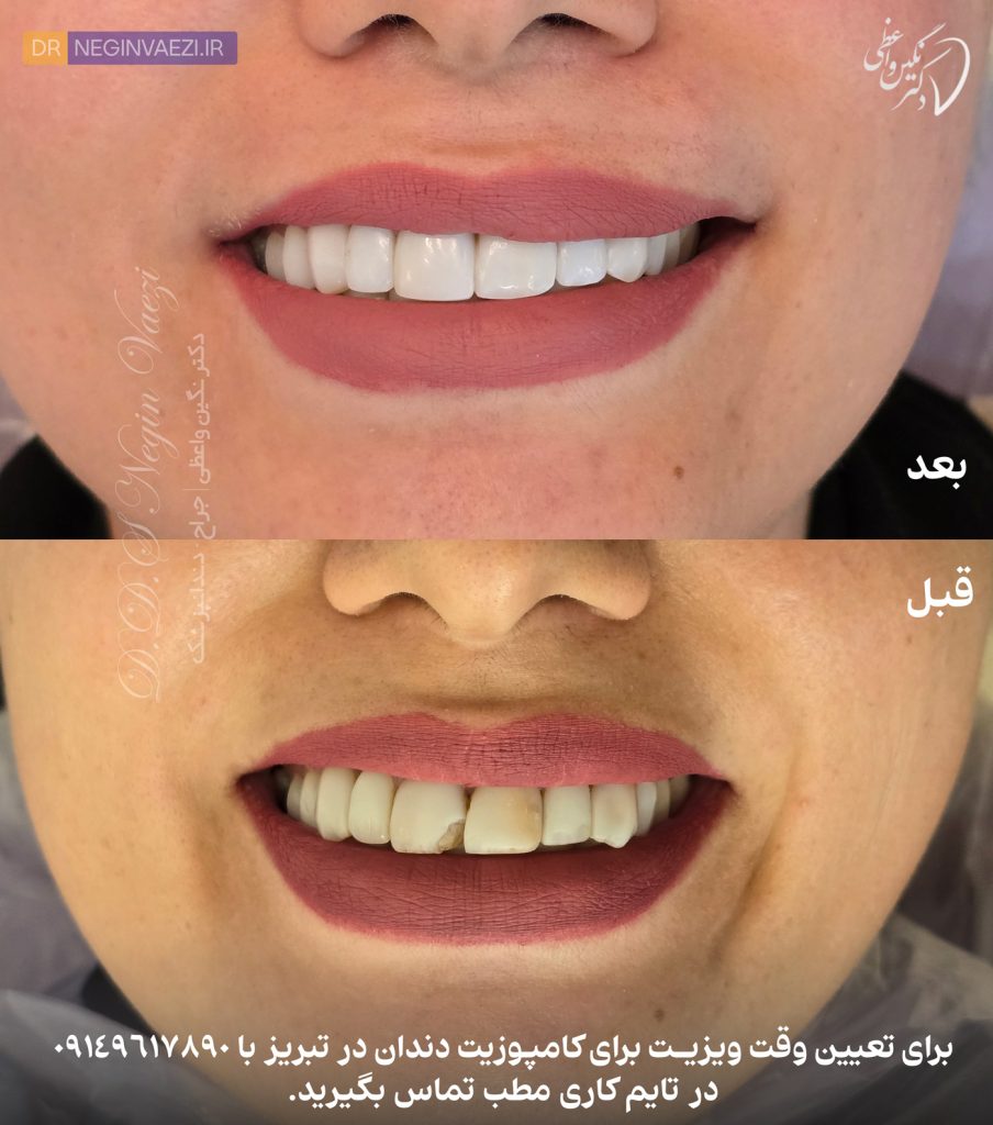 عکس قبل و بعد ونیر کامپوزیتی در تبریز، کامپوزیت زیبایی دندان ها در تبریز با برند سارکو 8 واحد به رنگ sw در مطب ولیعصر دکتر نگین واعظی
