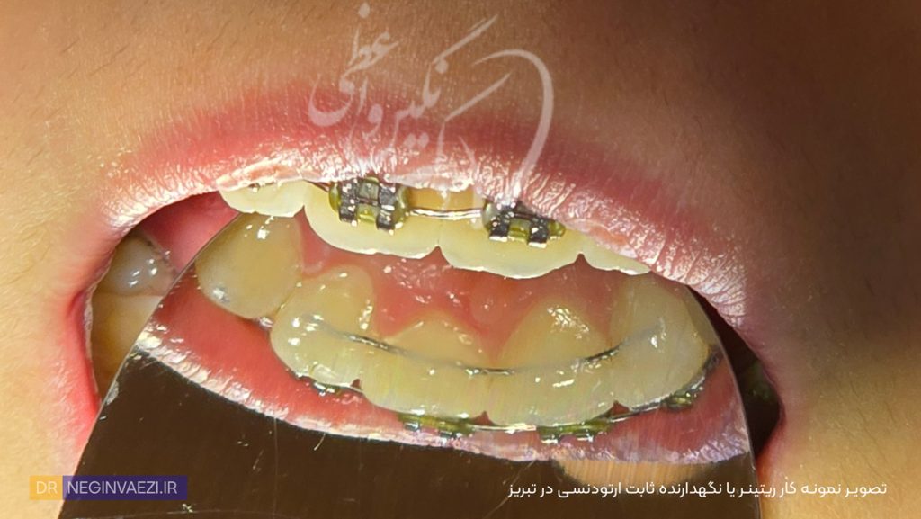 فیکس ریتینر یا ریتینر ثابت ارتودنسی در تبریز , نگهدارنده ثابت ارتودنسی در تبریز هزینه ریتینر ثابت در تبریز قیمت نگهدارنده ثابت ارتودنسی