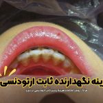 قیمت و هزینه فیکس ریتینر , هزینه نگهدارنده ثابت ارتودنسی در تبریز