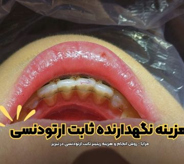 قیمت و هزینه فیکس ریتینر , هزینه نگهدارنده ثابت ارتودنسی در تبریز