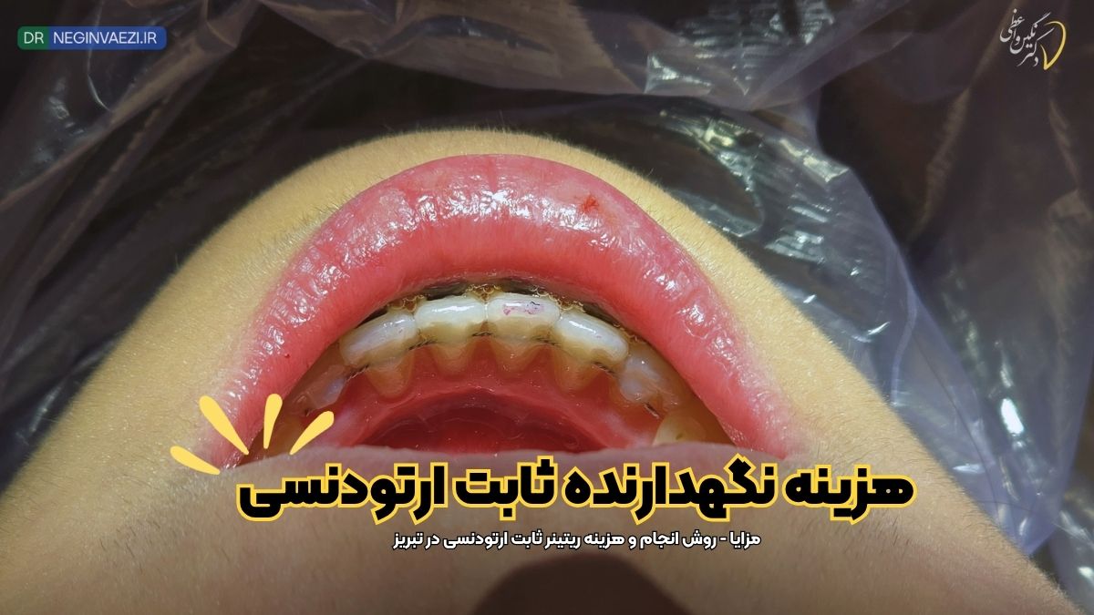 قیمت و هزینه فیکس ریتینر , هزینه نگهدارنده ثابت ارتودنسی در تبریز