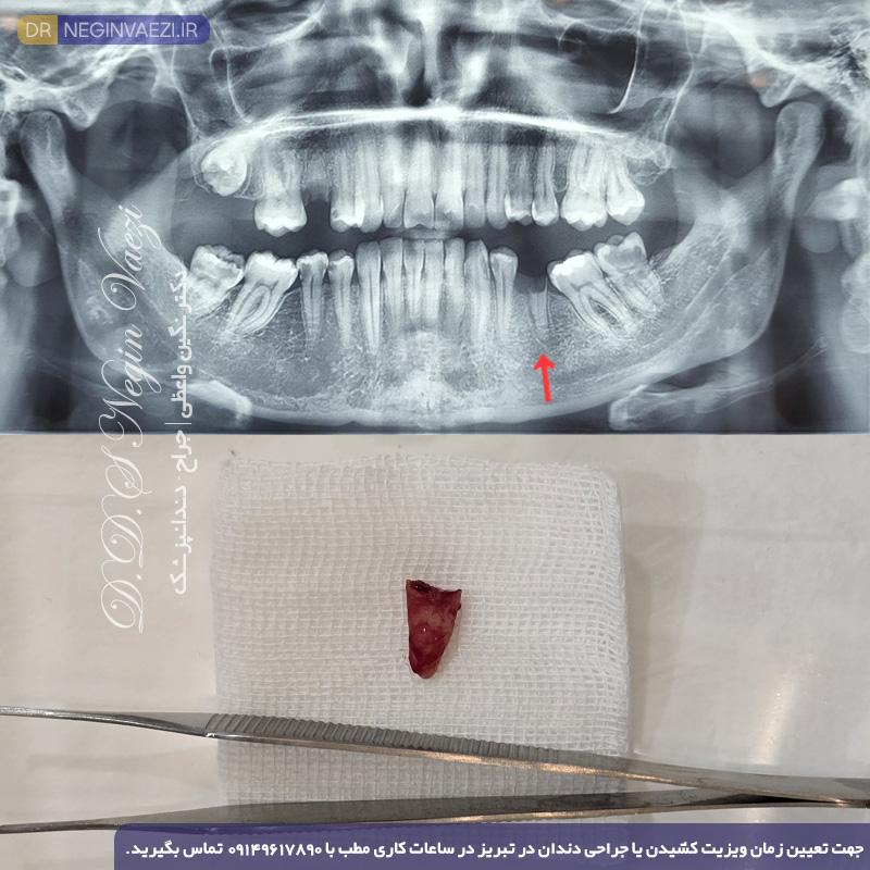 عکس قبل و بعد نمونه کار جراحی دندان عفونی و باقیمانده ریشه در لثه در تبریز در مطب دکتر نگین واعظی ولیعصر تبریز
