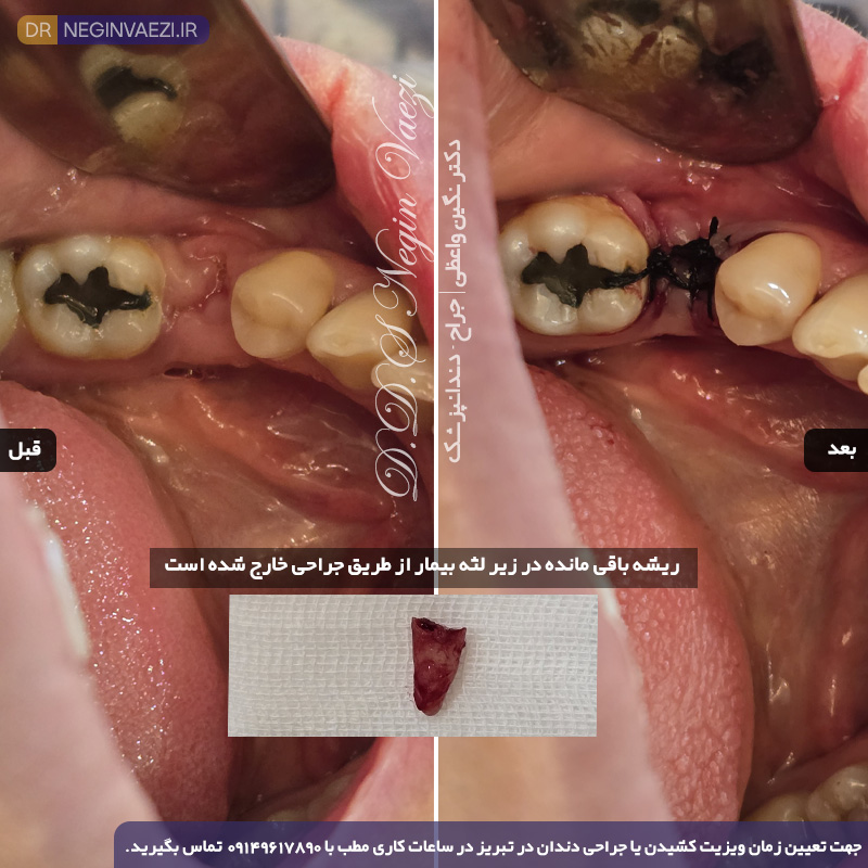 Portfolio infected dental surgery drneginvaezi tabriz 09149617890 02