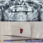 عکس قبل و بعد نمونه کار جراحی دندان عفونی ریشه باقیمانده در تبریز در مطب دکتر نگین واعظی واقع در ولیعصر بدون درد با بی حسی موضعی و انجام بخیه