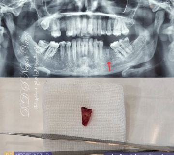 عکس قبل و بعد نمونه کار جراحی دندان عفونی ریشه باقیمانده در تبریز در مطب دکتر نگین واعظی واقع در ولیعصر بدون درد با بی حسی موضعی و انجام بخیه