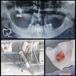 Wisdom surgery portfolio tabriz drneginvaezi 09149617890 150x150