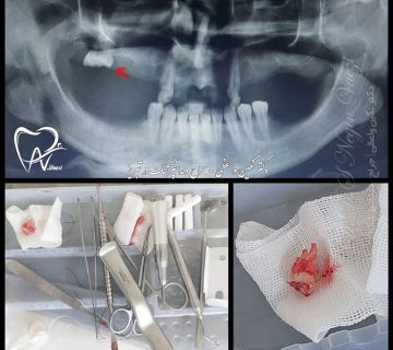 Wisdom surgery portfolio tabriz drneginvaezi 09149617890 360x320