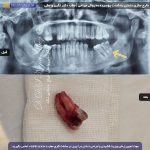 عکس نمونه کار خارج سازی جراحی دندان پوسیده | مطب دکتر نگین واعظی | ولیعصر | تبریز