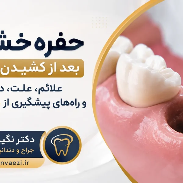 حفره خشک بعد از کشیدن دندان؛ علائم و درمان درای ساکت Dry socket