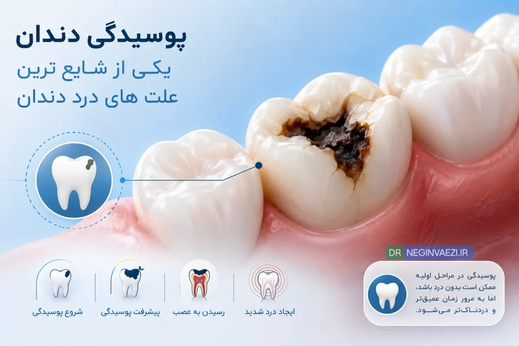 پوسیدگی دندان یکی از دلایل شایع درد ناگهانی دندان می باشد 