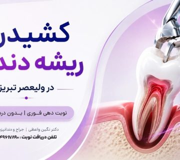 جراحی و کشیدن ریشه شکسته دندان در تبریز   کشیدن ریشه باقی مانده دندان دکتر نگین واعظی ولیعصر تبریز هزینه قیمت و مراحل