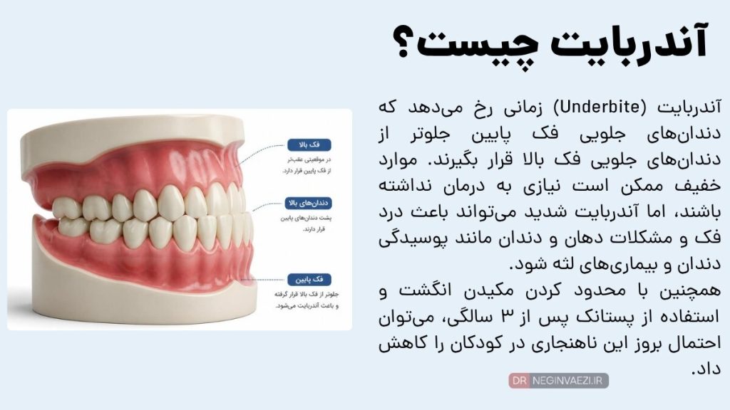 آندربایت چیست؟ جلو بودن فک پایین نسبت به فک بالا