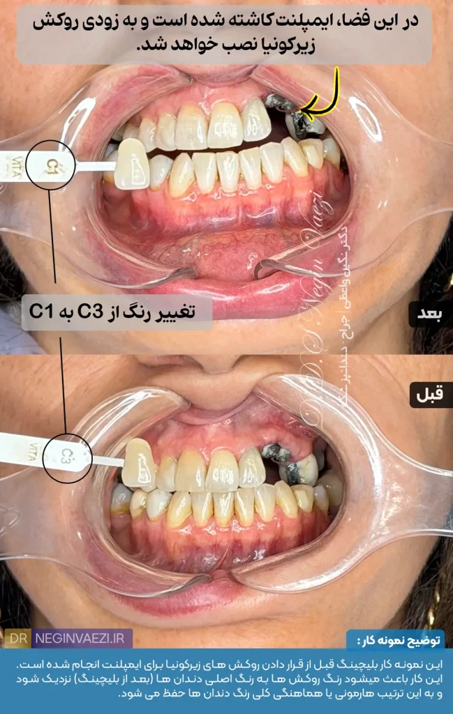 نمونه کار بلیچینگ تبریز ولیعصر دکتر نگین واعظی 649x1024
