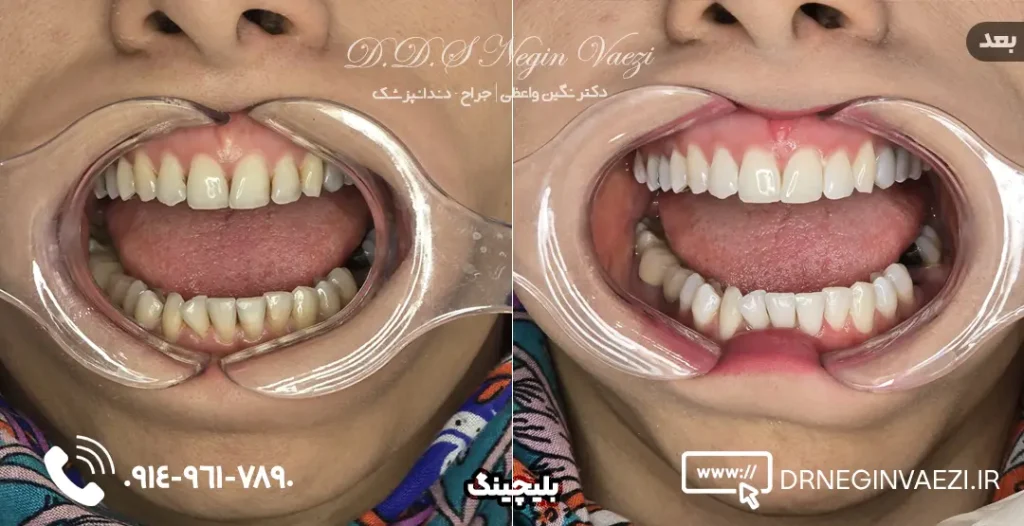 نمونه کار بلیچینگ دندان در تبریز  ولیعصر   دکتر نگین واعظی