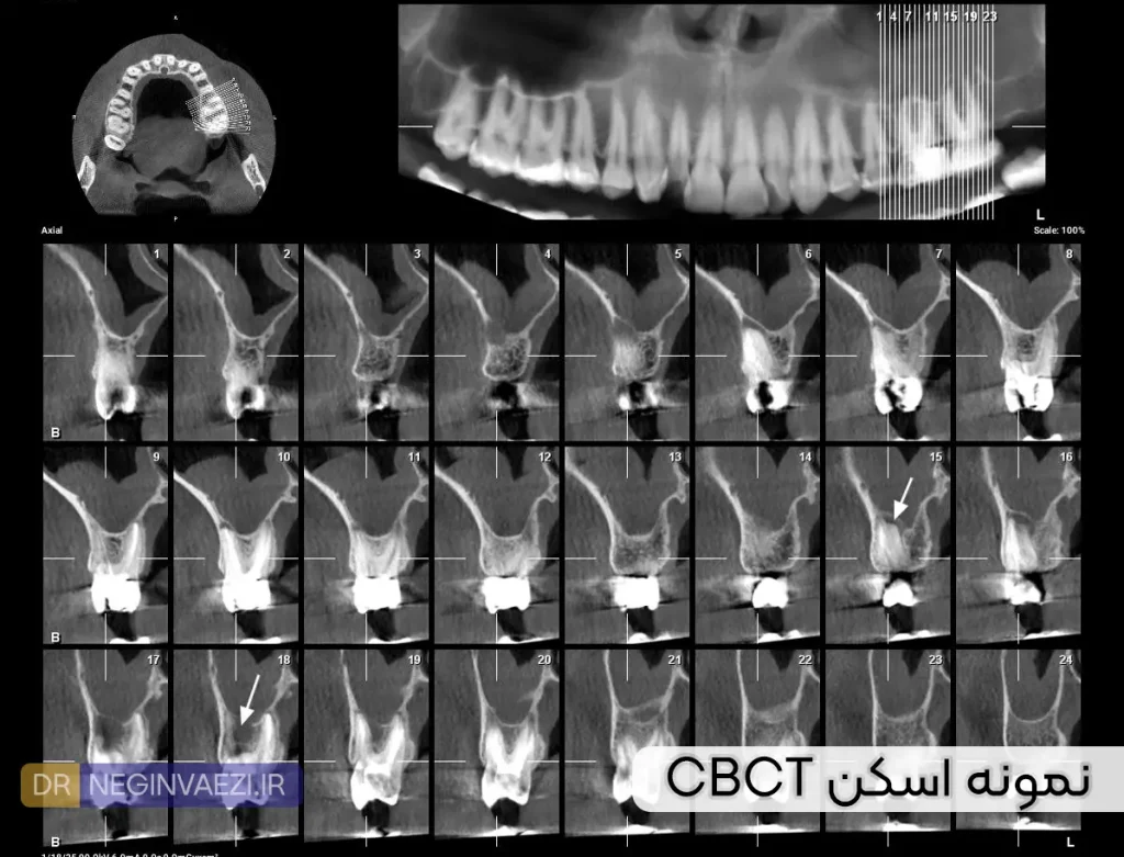 نمونه اسکن CBCT جهت بررسی تحلیل ریشه و استخوان فک