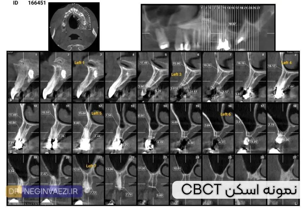 نمونه تصویر اسکن CBCT قبل از ایمپلنت دندان