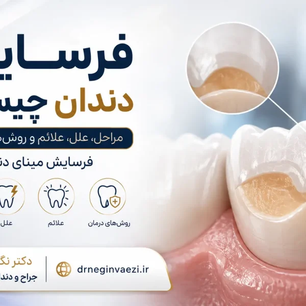 فرسایش مینای دندان Tooth Erosion و علائم نازک شدن مینای دندان