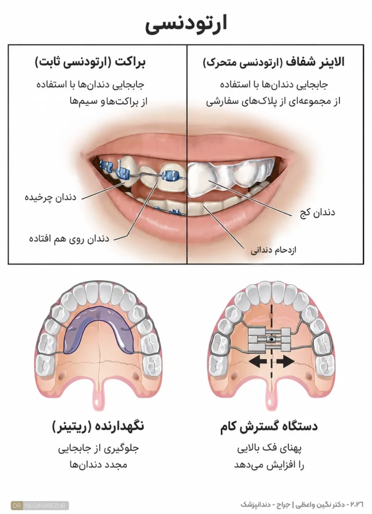 ارتودنسی چیست و انواع آن الاینر شفاف و براکت ثابت