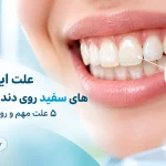 علت لکه های سفید و گچی روی دندان و روش های درمان آن