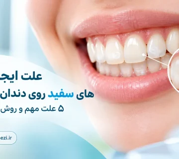 علت لکه های سفید و گچی روی دندان و روش های درمان آن