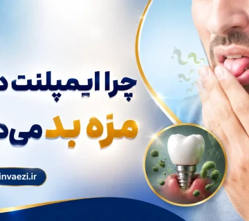 Bad taste after dental implant dr negin vaezi 360x320