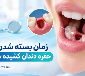 زمان بسته شدن حفره دندان کشیده شده