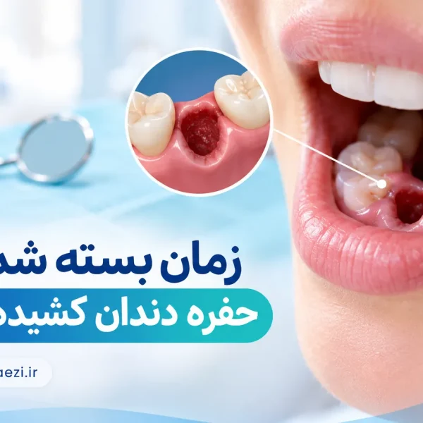 زمان بسته شدن حفره دندان کشیده شده